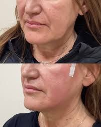 Antes e Depois — Bioestimuladores