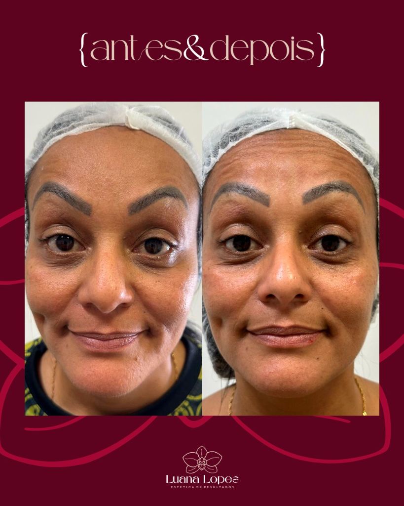 Antes e Depois — Harmonização Facial