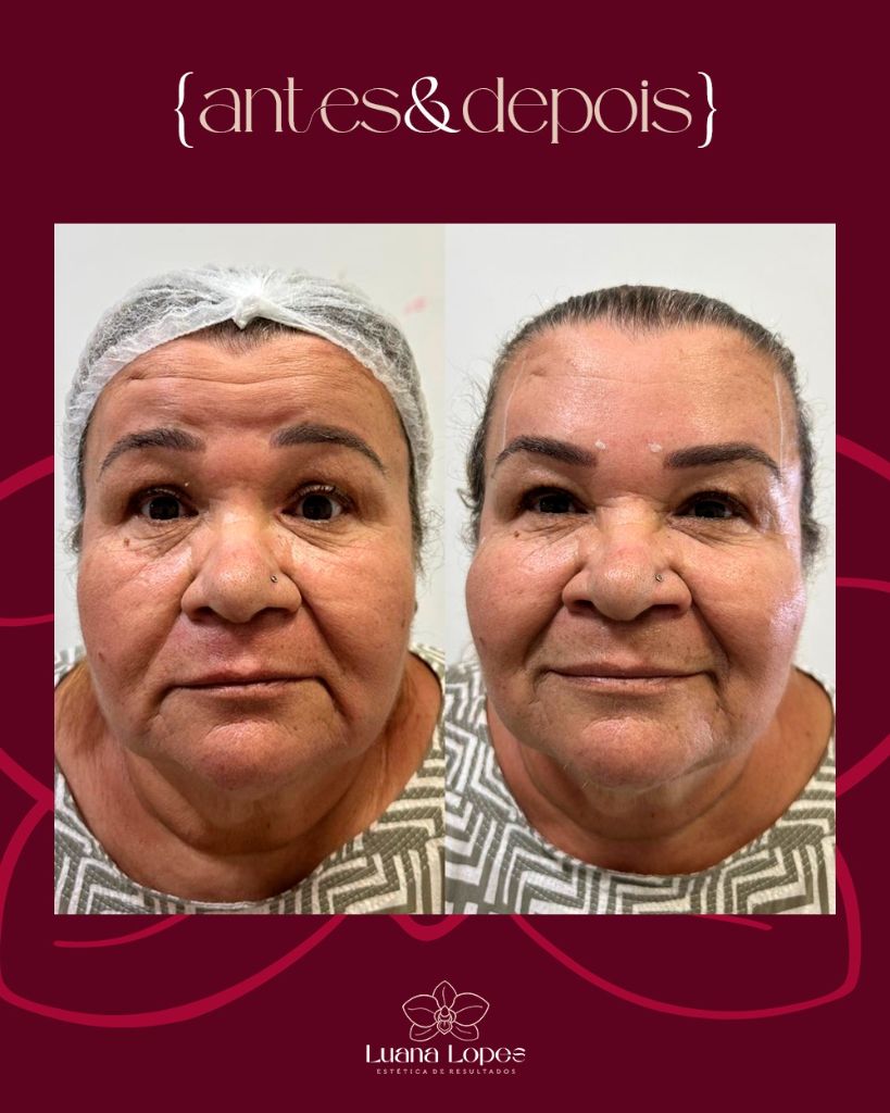 Antes e Depois — Bioestimuladores