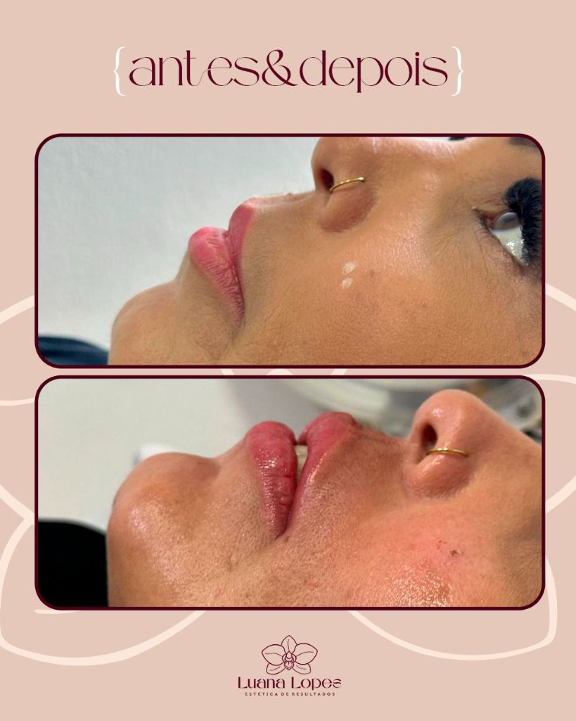 Antes e Depois — Preenchimento Labial