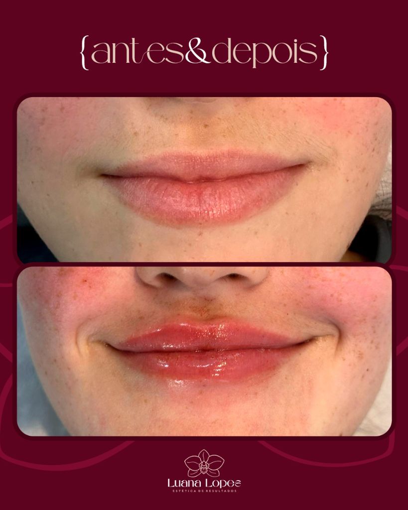 Antes e Depois — Preenchimento Labial