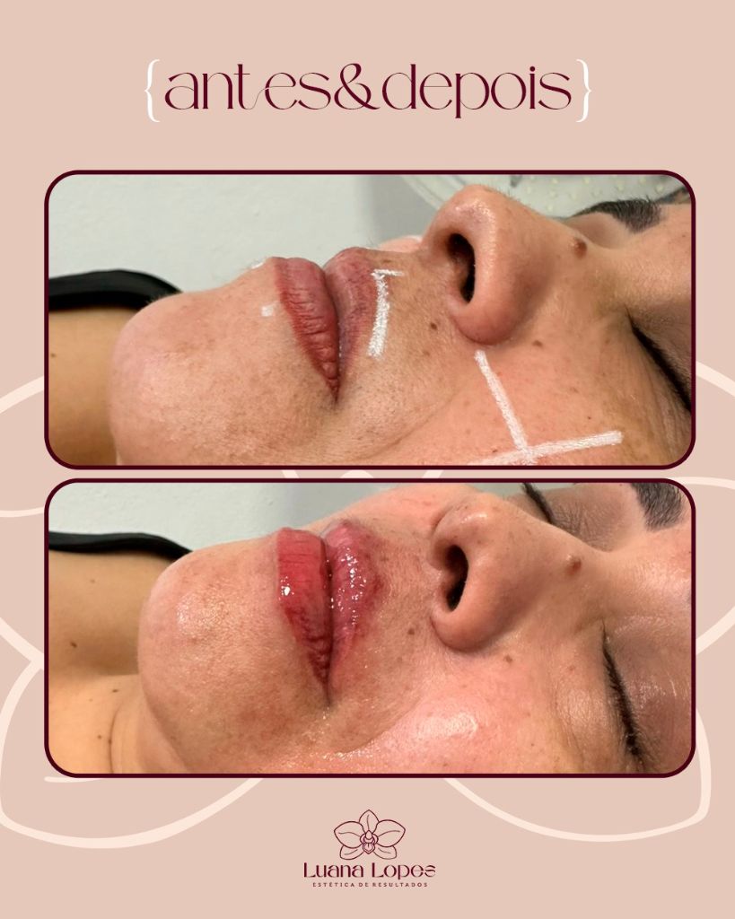 Antes e Depois — Preenchimento Labial