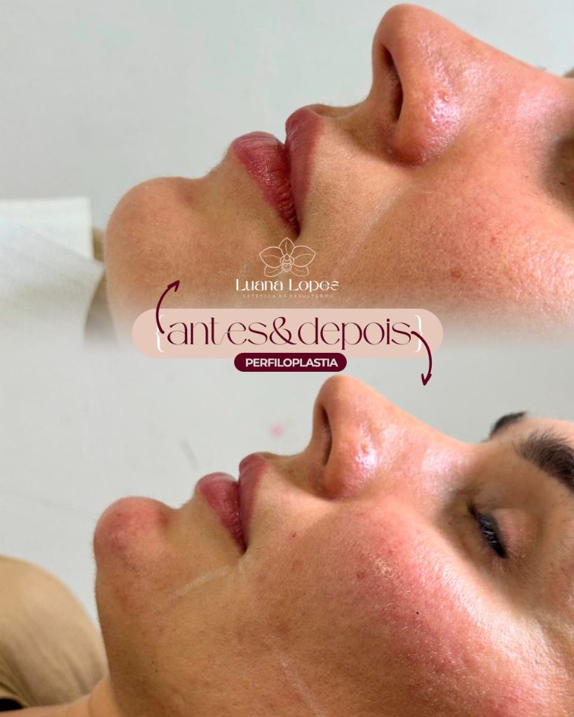 Antes e Depois — Perfiloplastia