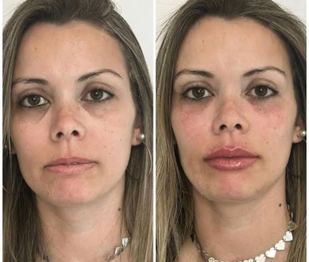 Antes e Depois — Preenchimento Facial